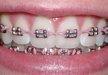 Braces