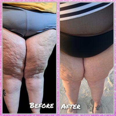 Cellulite reduction