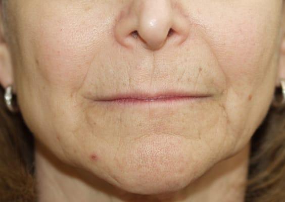 Rosenthal Liquid Facelift: Before 55 year old.  Radiesse for cheeks and jaw & Juvederm around the mouth.