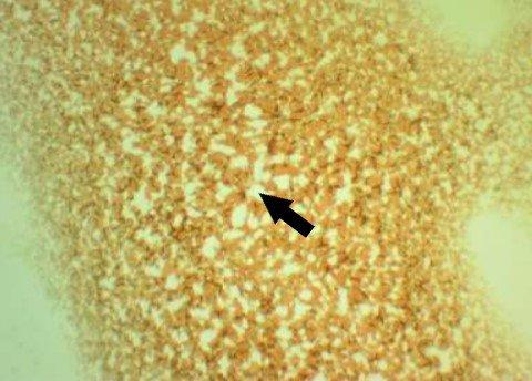 Dry Blood Cell Analysis: The white spaces indicate oxidative stress. This person needs antioxidants.