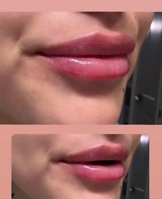 After with Versa lip filler