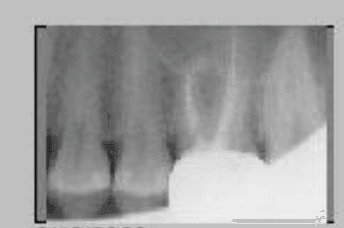 X-Rays after (Poor quality. Will update later).