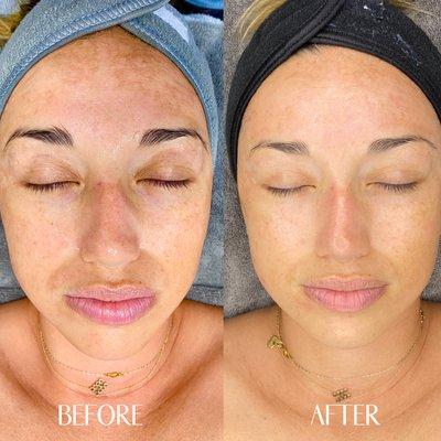 Before and after microneedling