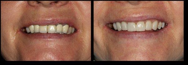 Yet another Beautiful Smile Transformation by Dr Sheila Naik! "Changing Lives by Changing Smiles!"