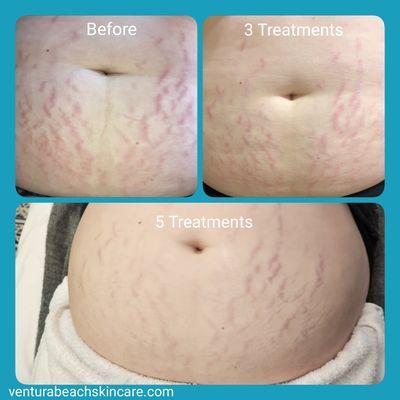 These are amazing results from our pain-free, all natural,  hyperpigmentation lightening treatments.