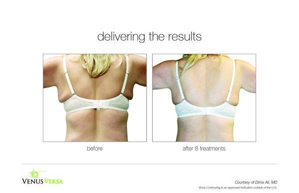 Before & After | Body Contouring | 8 treatments *results vary between clients*