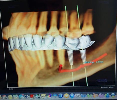 We are supported by a full radiology department with the latest in 3D imaging to plan our patient's cases from plan...