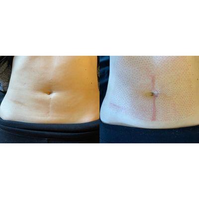 Before and during skin tightening treatment for loose skin