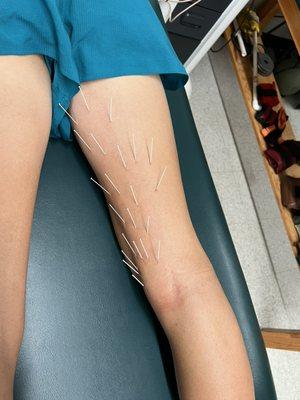 If your active and get a strained muscle, immediate dry needling helps drastically reduce healing time frame!