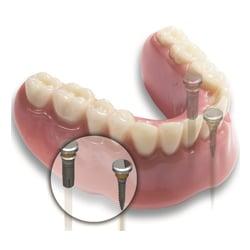 Dental implants