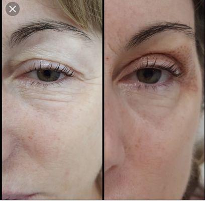 Eyelid lift and crows feet