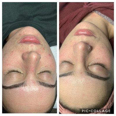 Before and after on Microdermabrasion facial treatment package of 6!