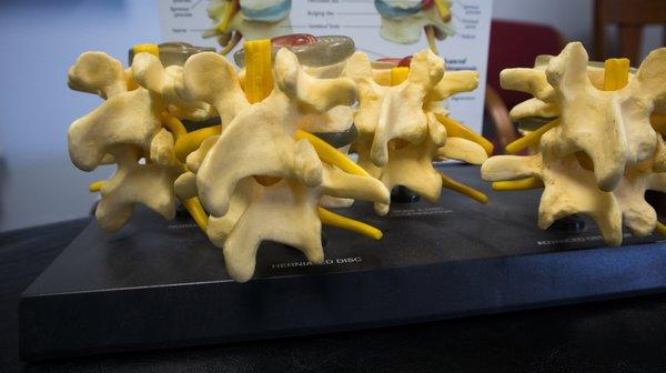 Display of a herniated disc.