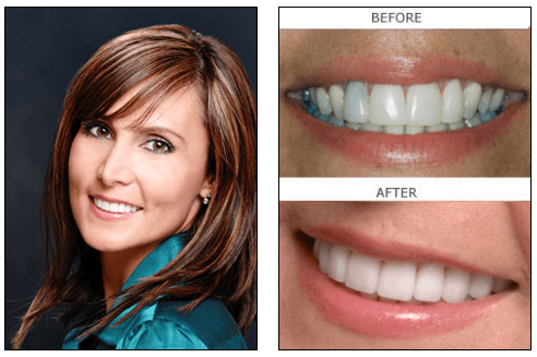 Porcelain veneers patient