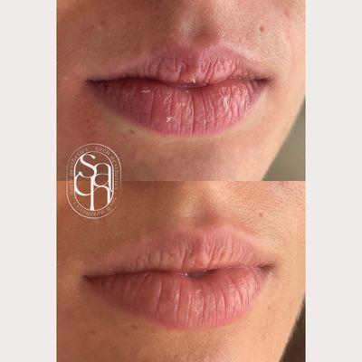 Before and after of a natural lip filler enhancement after is has settled a few weeks after injections.