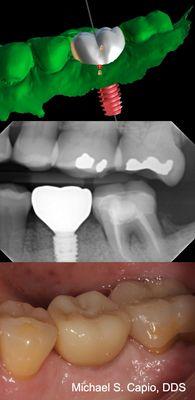 We use computer generated guides to increase safety and enhance the result.  This is Dr. Capio's special area of interest.