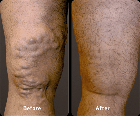 Before and after Vein Treatment at USA Vein Clinics in Woodbury, MN