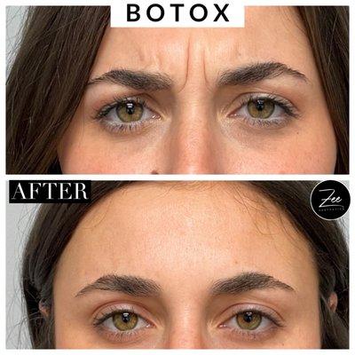 Wrinkle Prevention Botox