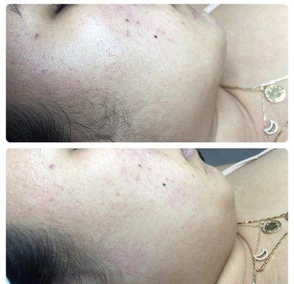 Dermaplaning facial