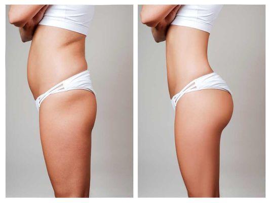 8 sessions of Body Contouring and Non-invasive Butt lifting