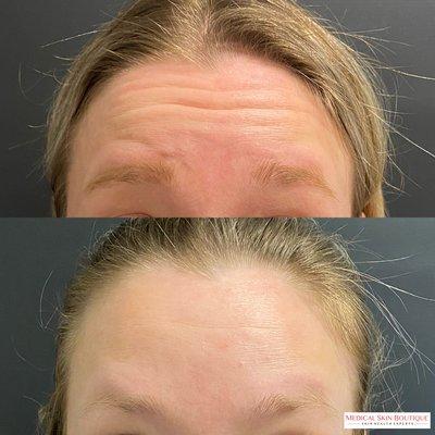 Botox for forehead wrinkles