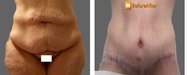 Tummy Tuck (Abdominoplasty) with flankplasty and lateral thigh lift