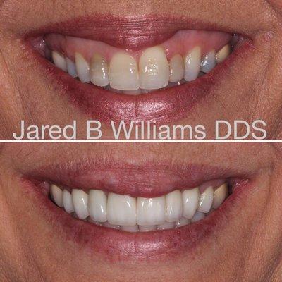 Crowns, Veneers, Smile Makeover