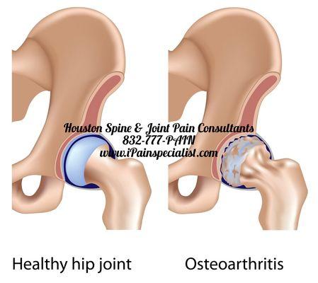 Call our-Pain Management Clinic. Our Pain Doctors will offer  NON-SURGICAL management of the hip pain.