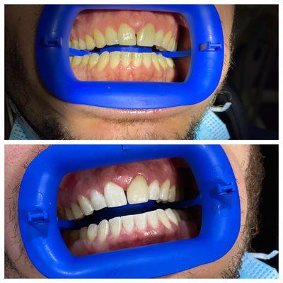 Zoom Teeth Whitening before and after results