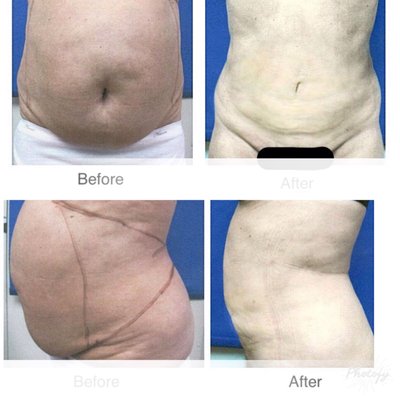 Body jet lipo/tummy tuck