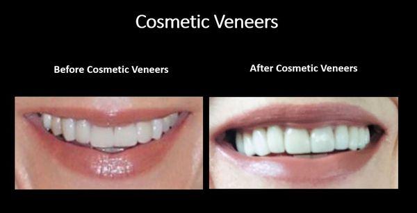 Porcelain Veneers Before and After