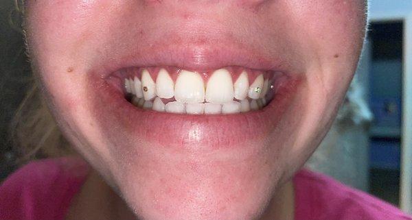 Teeth Whitening & Tooth Gems