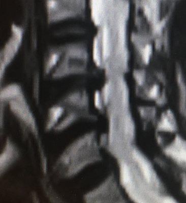 All kinds of spine and body problems. All your joints: big n small; left n right!!! Here is a big disc herniation in the cervical spine/neck