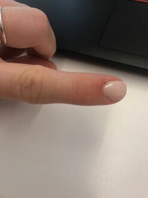 Infected cuticle