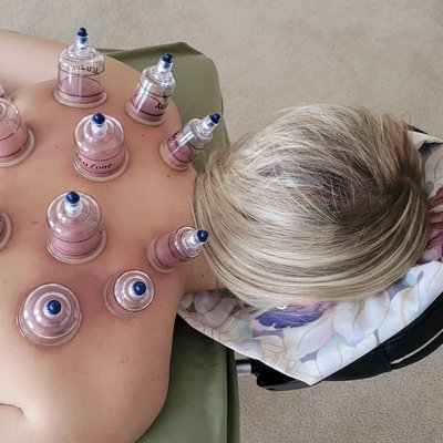 Cupping is offered to those who are candidates.