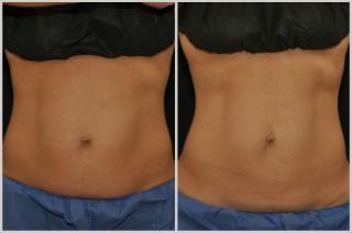 Reshape with Coolscuplting. Call for a free Consultation 205-822-8787