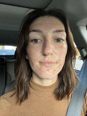 Hormonal acne, pre facial