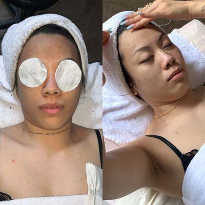 Classic Facial before & after