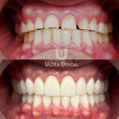 Ultra Smile Makeover