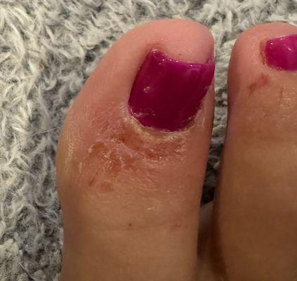 Two days after pedicure.