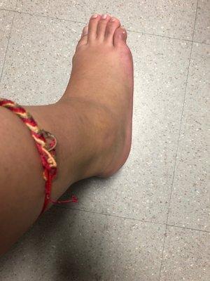 Ankle