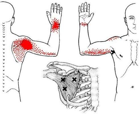 Relentless shoulder pain? Don't neglect your Subscapularis!  Don't know what that is? Come see me: www.wellpsringtherapeutics.setmore.com