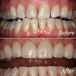 Improve your smile with porcelain veneers