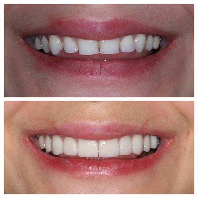 Porcelain Dental Veneers #porcelainveneer #cosmeticdentistry #cosmeticdentist #cosmeticdentaloffice