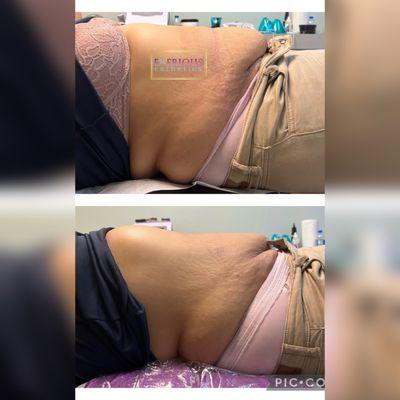 Lipomelt fat reduction body contouring