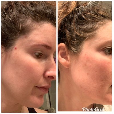 Left is after microneedling and photo facial!