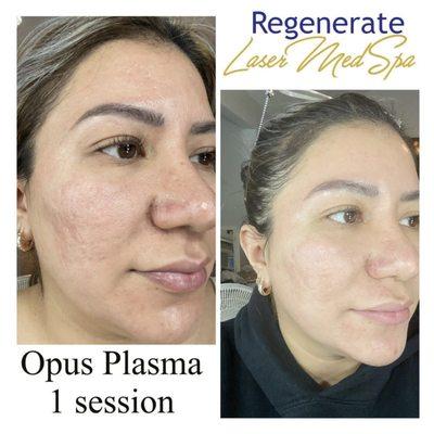 OPUS Plasma 
 Great treatment for acne scars!