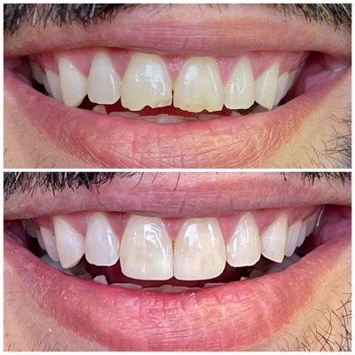 Natural repair of broken teeth.