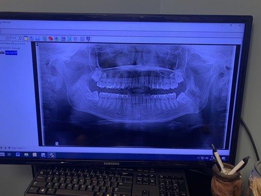 Wisdom teeth X-ray