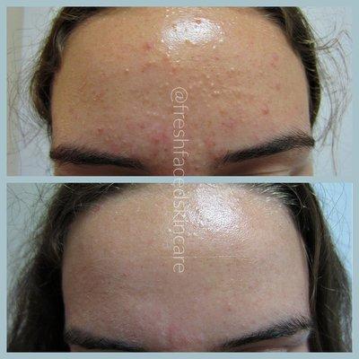 Before & After from In The Clear Acne Treatment (series of 4)